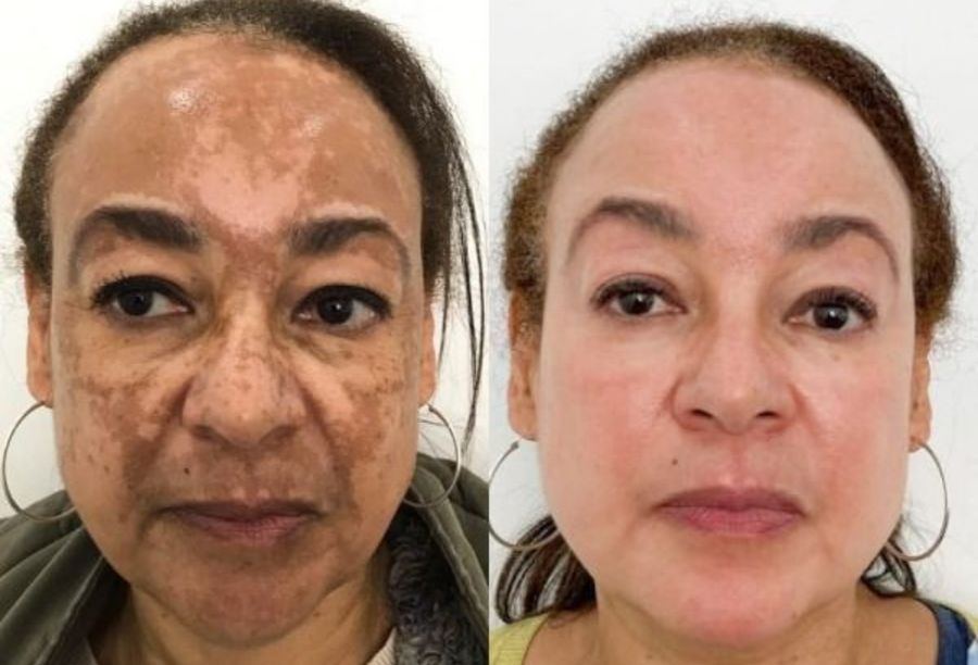 Before / After